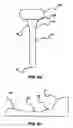 Fig. 09 - Apparatus and method for hypothermia and rewarming by altering the temperature of the cerebrospinal fluid in the brain