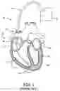 Fig. 02 - Method and apparatus for endovenous pacing lead