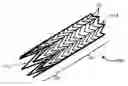 Fig. 01 - Ostial stent