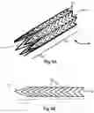 Fig. 03 - Ostial stent