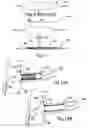 Fig. 06 - Ostial stent