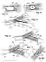 Fig. 08 - Ostial stent