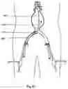 Fig. 45 - Vascular fixation device and method