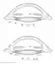 Fig. 03 - Ophthalmological zonular stretch segment for treating presbyopia
