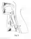 Fig. 04 - Laryngotracheal devices and methods of use thereof