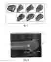 Fig. 07 - Laryngotracheal devices and methods of use thereof