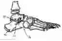 Fig. 01 - Subtalar implant assembly