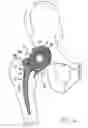 Fig. 04 - One piece snap fit acetabular cup