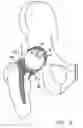 Fig. 06 - One piece snap fit acetabular cup