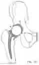 Fig. 08 - One piece snap fit acetabular cup