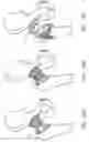 Fig. 28 - One piece snap fit acetabular cup