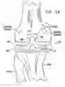 Fig. 32 - One piece snap fit acetabular cup