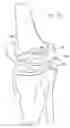 Fig. 35 - One piece snap fit acetabular cup