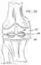 Fig. 40 - One piece snap fit acetabular cup