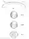 Fig. 02 - Method for keratophakia surgery