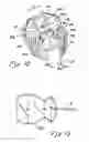 Fig. 07 - Sutureless implantable device and method for treatment of glaucoma