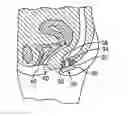 Fig. 01 - Anal hygienic pad and method of use