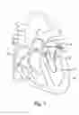 Fig. 02 - Cryo ablation coil