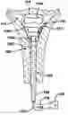 Fig. 01 - Device and method for ablation of body cavities