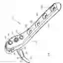 Fig. 02 - System for stabilization of fractures of convex articular bone surfaces including subchondral support structure