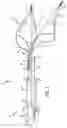 Fig. 02 - Embolic filtering devices for bifurcated vessels