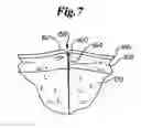 Fig. 08 - Dynamic bioabsorbable fastener for use in wound closure