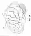 Fig. 05 - Treatment of epilepsy by high frequency electrical stimulation and/or drug stimulation