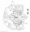Fig. 07 - Treatment of epilepsy by high frequency electrical stimulation and/or drug stimulation