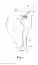 Fig. 02 - Apparatus for securing a therapy delivery device within a burr hole