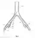 Fig. 06 - Introducer for an iliac side branch device