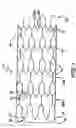 Fig. 02 - Intraluminal stent and graft