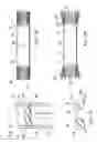 Fig. 07 - Percutaneously placed prosthesis with thromboresistant valve portion