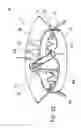 Fig. 09 - Percutaneously placed prosthesis with thromboresistant valve portion