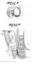 Fig. 02 - Prosthesis for aero-digestive fistulae