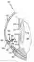 Fig. 01 - Glaucoma implant having MEMS filter module