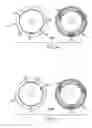 Fig. 03 - Method of adjusting variable flow infant feeding assembly
