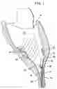 Fig. 02 - Decropping tool and wrapped cam for use in food processing machinery