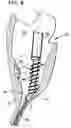 Fig. 06 - Decropping tool and wrapped cam for use in food processing machinery