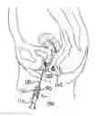Fig. 01 - Vaginal rejuvenation