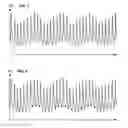 Fig. 03 - Real-time measurement of ventricular stroke volume variations by continuous arterial pulse contour analysis