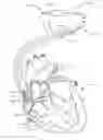 Fig. 01 - Method for guide catheter positioning