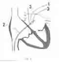 Fig. 07 - Balloon catheter