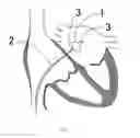 Fig. 08 - Balloon catheter