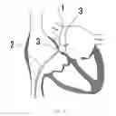 Fig. 09 - Balloon catheter