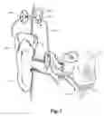 Fig. 02 - Combined stimulation for auditory prosthesis