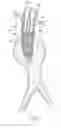 Fig. 04 - Systems and methods for attaching a prosthesis within a body lumen or hollow organ