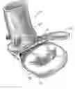 Fig. 01 - Method and apparatus for replacing a mitral valve and an aortic valve with a single homograft