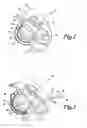 Fig. 02 - Body lumen device anchor, device and assembly