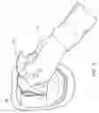 Fig. 03 - Denture adhesive removal method