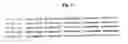 Fig. 03 - Determining a predisposition to cancer